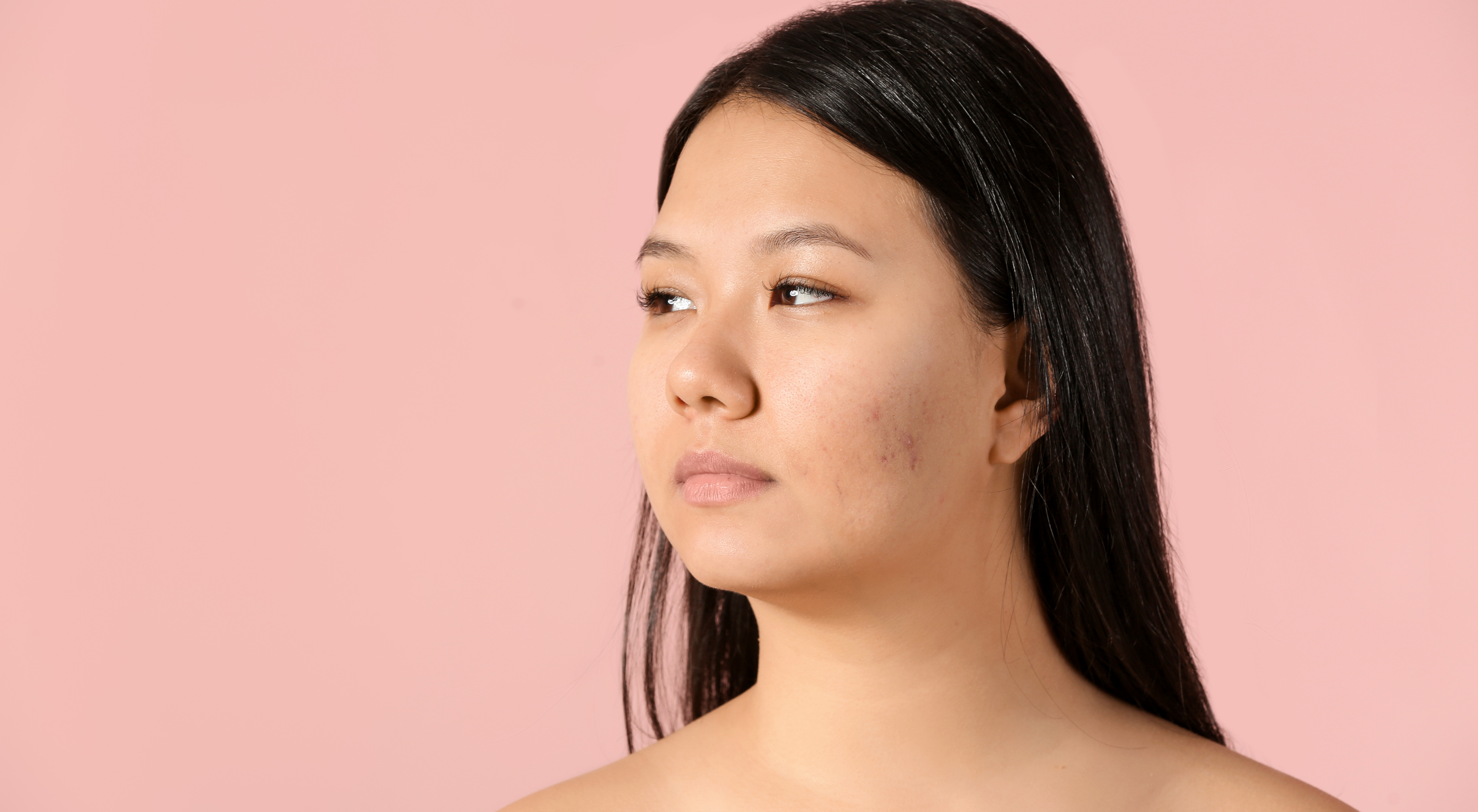 Acne & Constipation: Are They Linked?